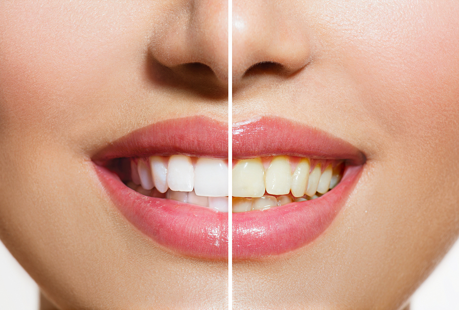 Teeth Whitening | Dentist in Springfield, MO | A. Joshua Montgomery, DDS