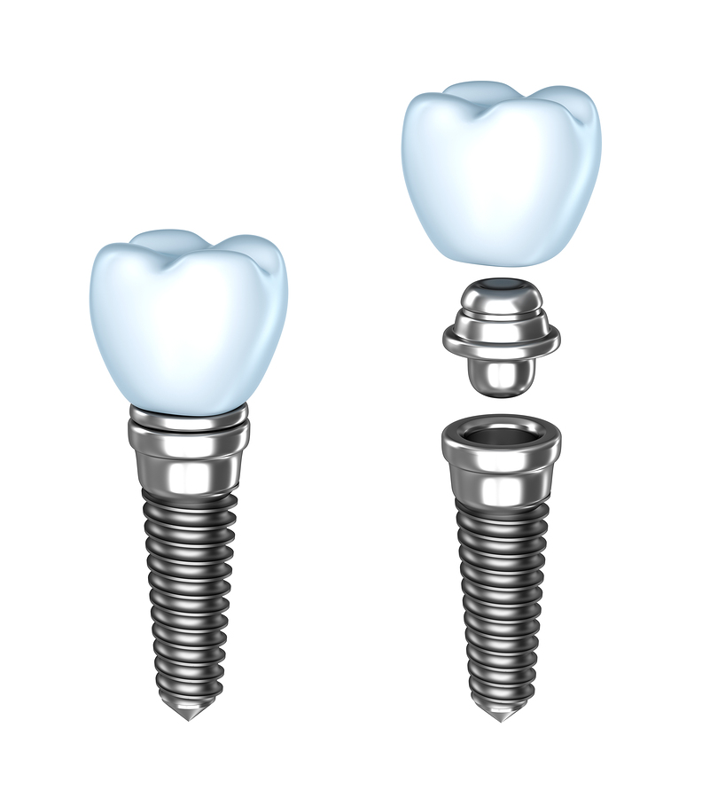 Dental Implants | Dentist in Springfield, MO | A. Joshua Montgomery, DDS